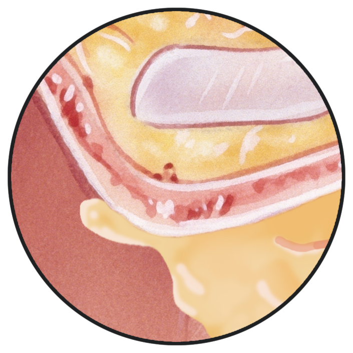 vaxol-korvavaha-muodostuu-705x705